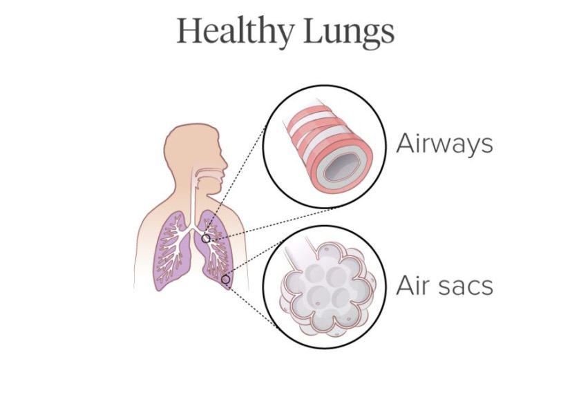 Pictures of COPD’s Effect on the Lungs