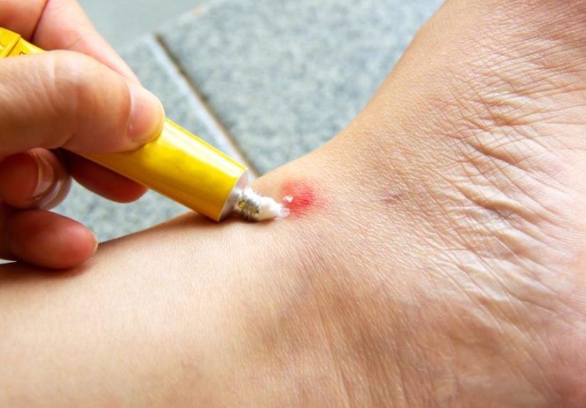 Remedios caseros para la picadura de mosquitos que son efectivos