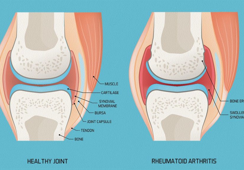 Rheumatoid Arthritis Disease Progression: An Overview