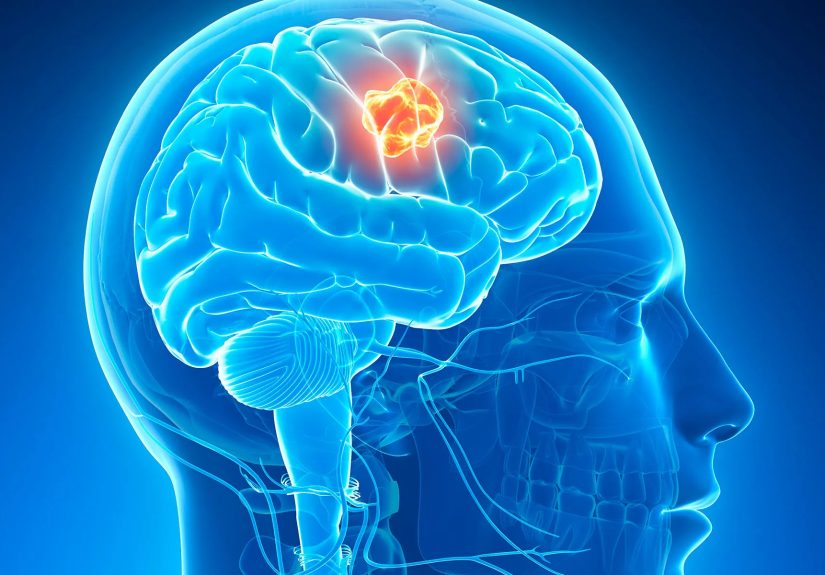 Brain Tumors: Causes, Symptoms, and Treatment Options