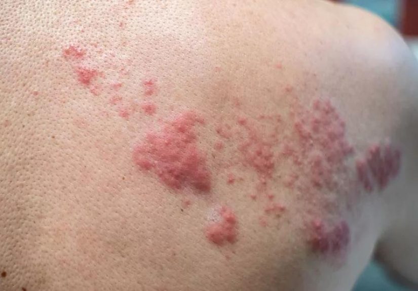 Can You Get Shingles If You've Never Had Chickenpox?