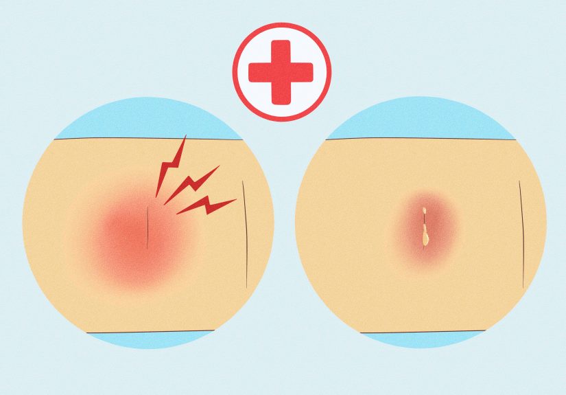 How to Remove Nexplanon: Where to Get It Removed & More