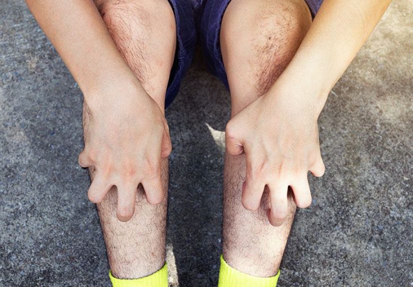 Is Cellulitis Itchy? Causes and Treatment