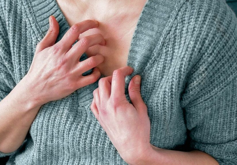 Should I Go to the Doctor for Hives? Treatment and Prevention