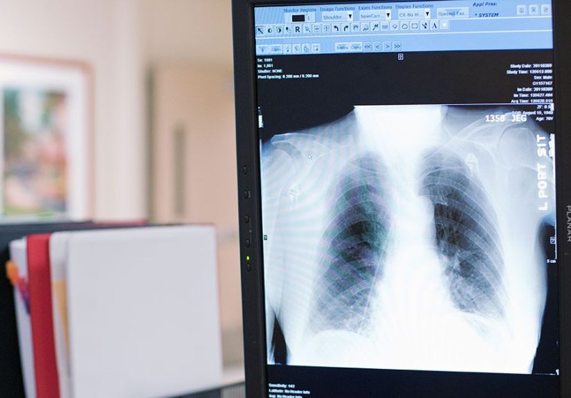 Squamous Cell Lung Carcinoma: Symptoms, Staging, & Treatment