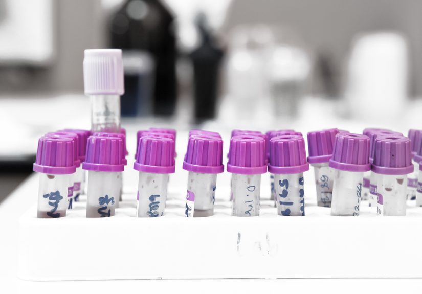 When an Erythrocyte Sedimentation Rate Leads to a Serious Diagnosis