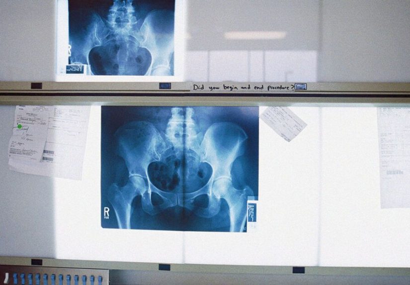 Bone Mineral Density (BMD): Test, Purpose, and Results