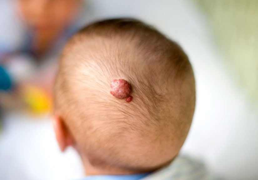Hemangioma of the Skin: Causes, Identification, and Diagnosis