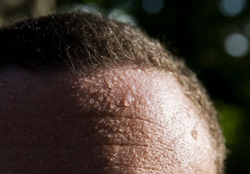 Hyperhidrosis: Symptoms, Causes, Diagnosis, and Treatment