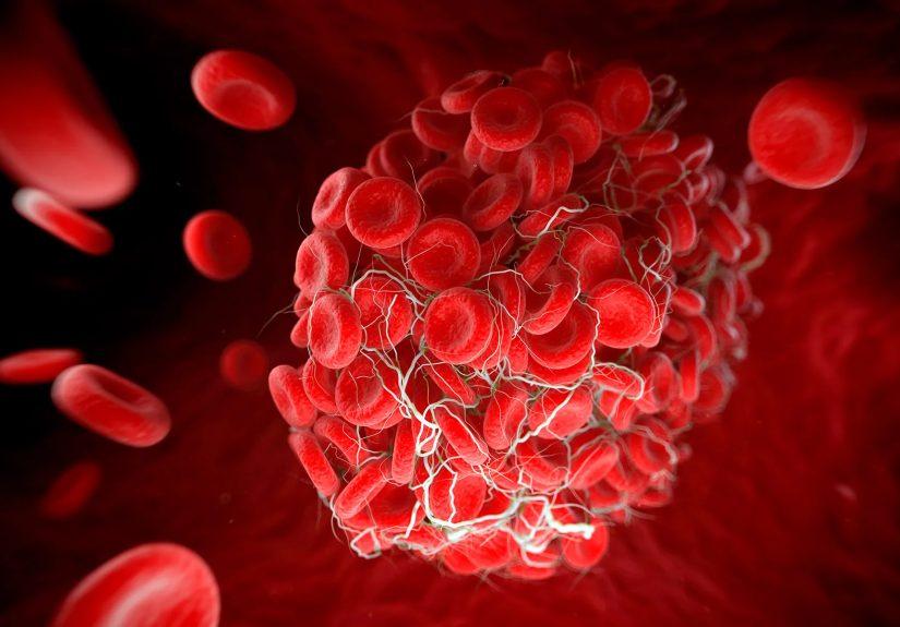 PNH and Possible Complications