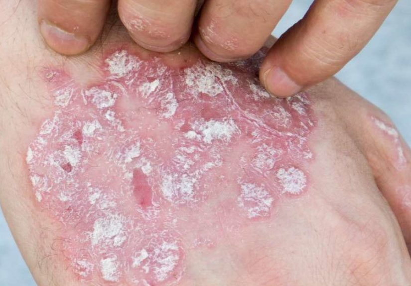 Psoriasis and Keratosis Pilaris: What to Know