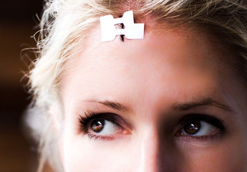 When to Get Stitches: How to Tell If Your Cut Needs Sewing Up